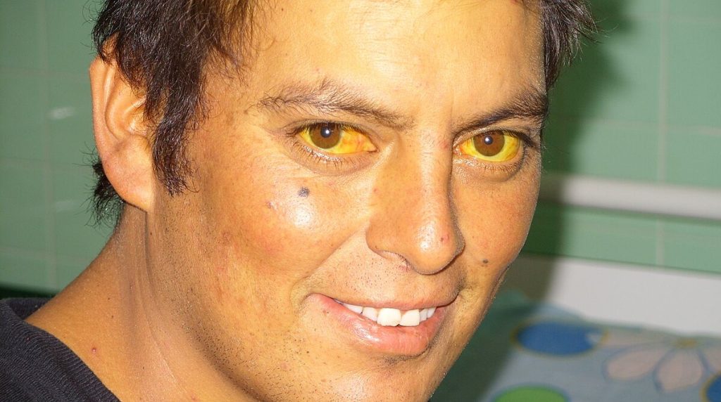 "Scleral_Icterus” by Sheila J. Toro is licensed under CC BY 4.0 A patient with scleral icterus, or jaundice
