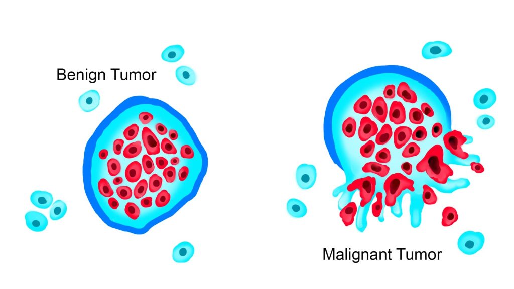“Tumor_Types_MTK.jpg” by WolfpackBME is licensed under CC BY-SA 4.0 Illustration of benign and malignant tumors