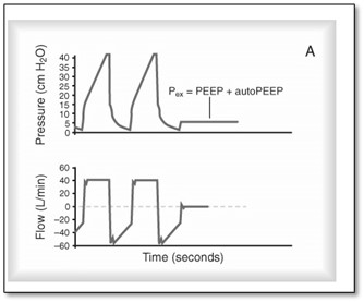 Illustration showing the expiratory pause with auto peep
