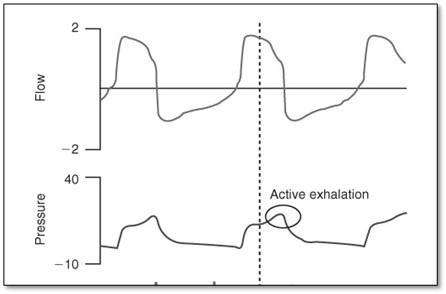 Illustration showing active exhalation by evaluating the pressure curve waveform