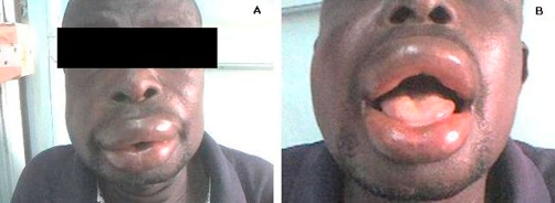 A person with extremely swollen lips from an allergic reaction