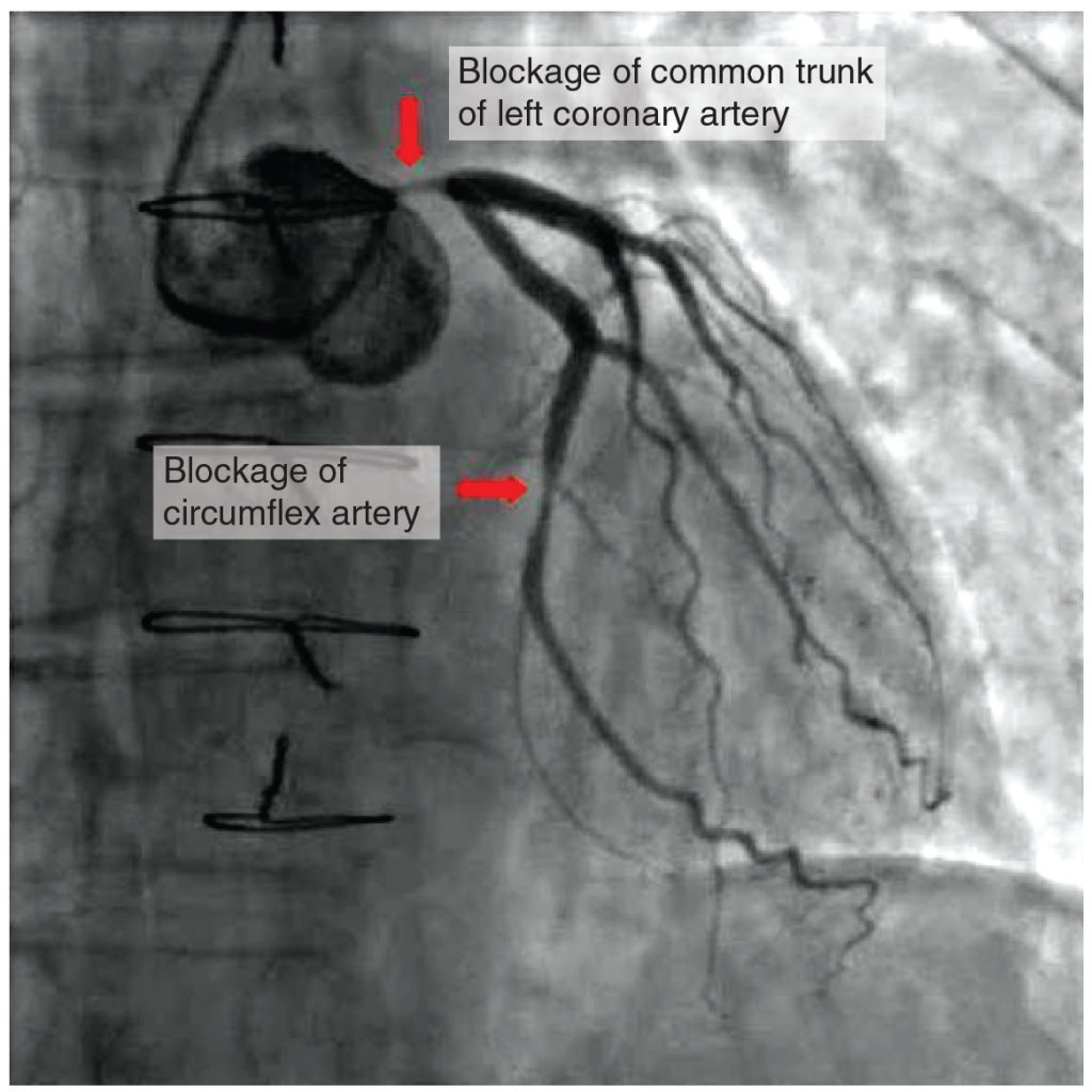 Blockages in arteries