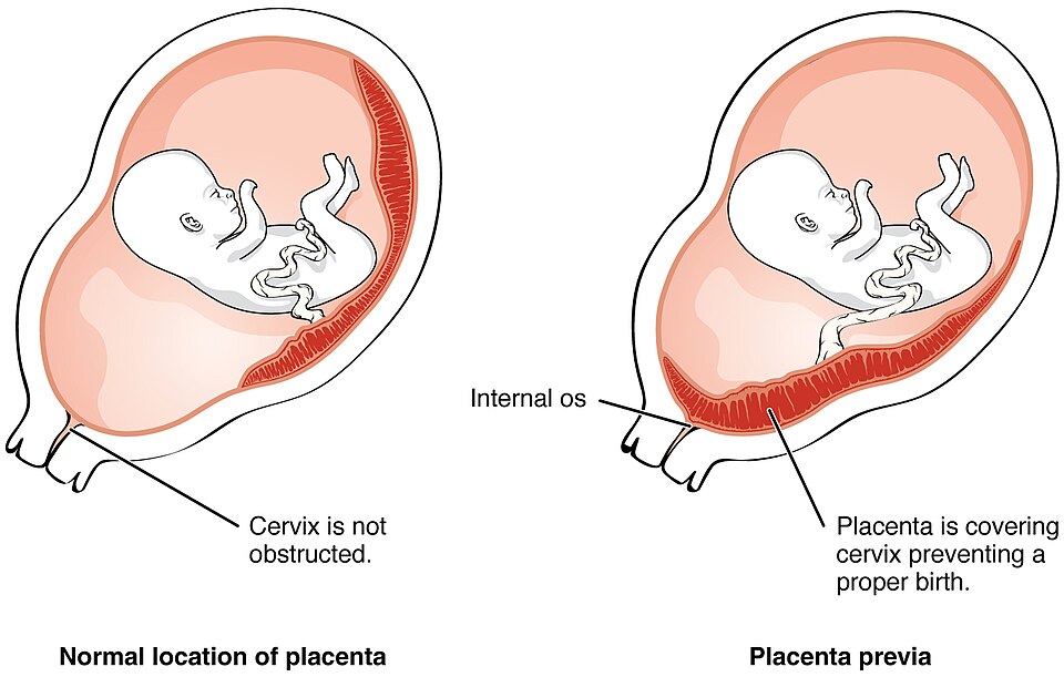 Illustration comparing normal location of placenta with placenta previa
