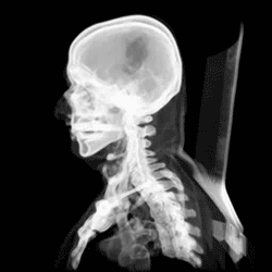 Animated 3d CT scan of the skull next and upper thoracic