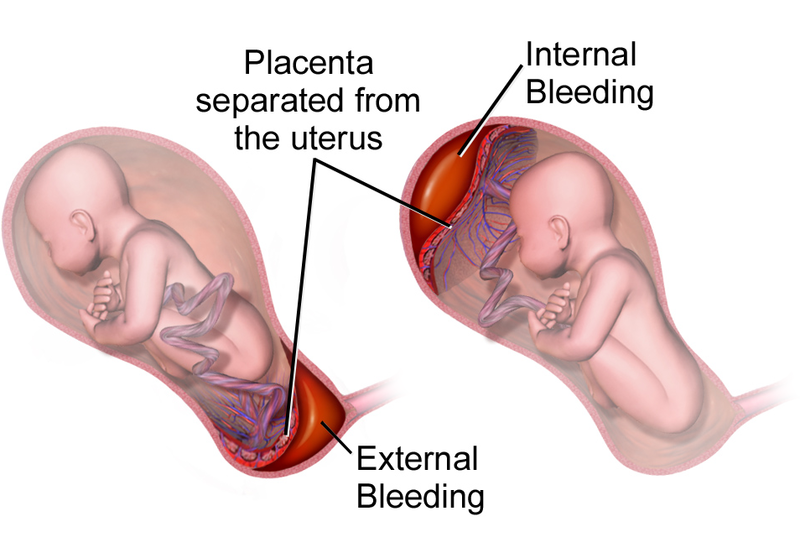 Illustration showing both a Partial placenta previa with abruption and a Normally planted placenta with abruption