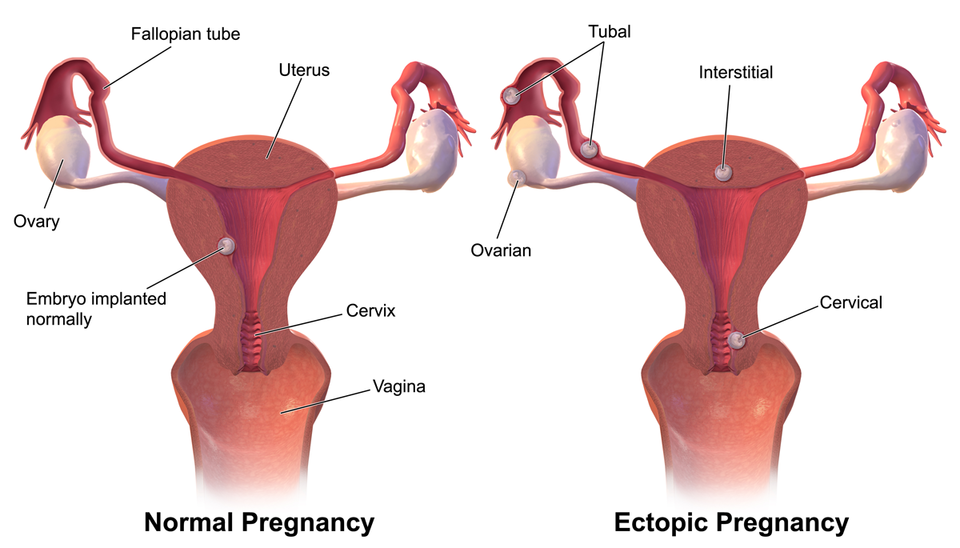 Illustration comparing a normal pregnancy with one that is ectopic
