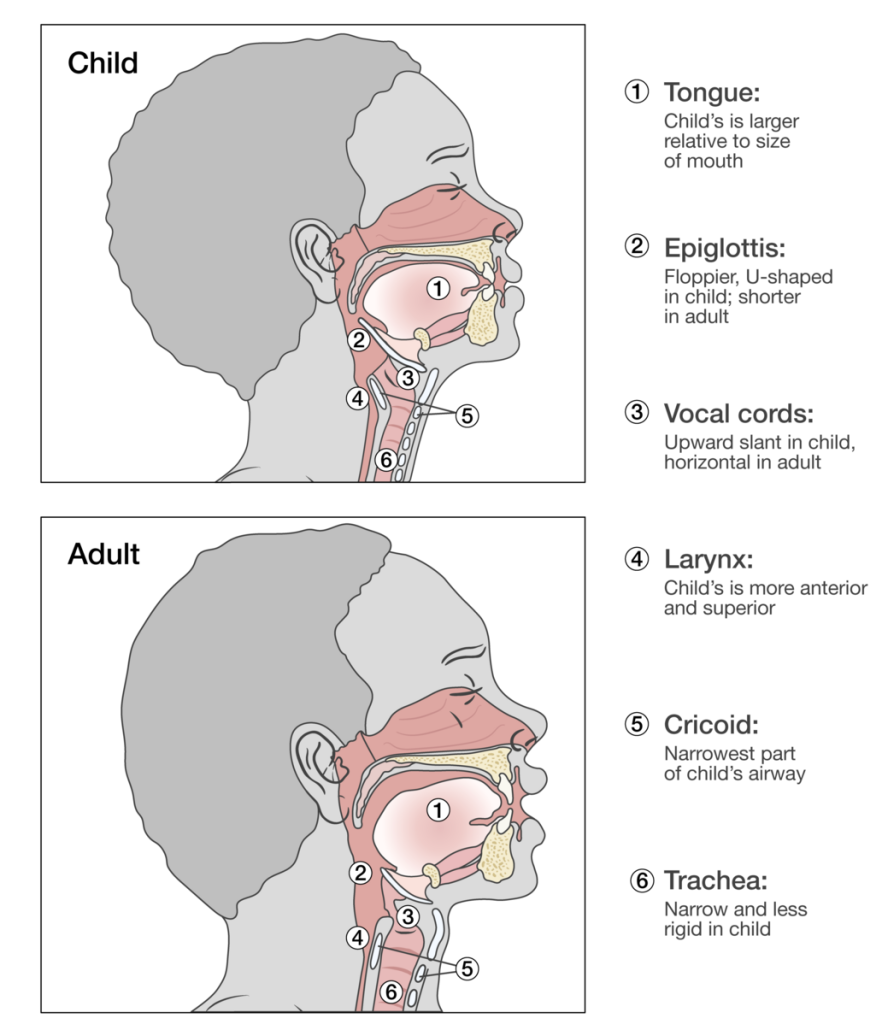 Illustration showing the difference, with text description, between child and adult airways