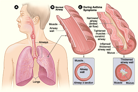 Illustration showing location of airways in lungs, along with a comparison between a normal airway and one affected by asthma