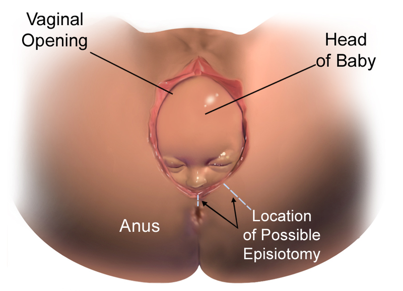 Illustration showing a baby's head crowning during delivery