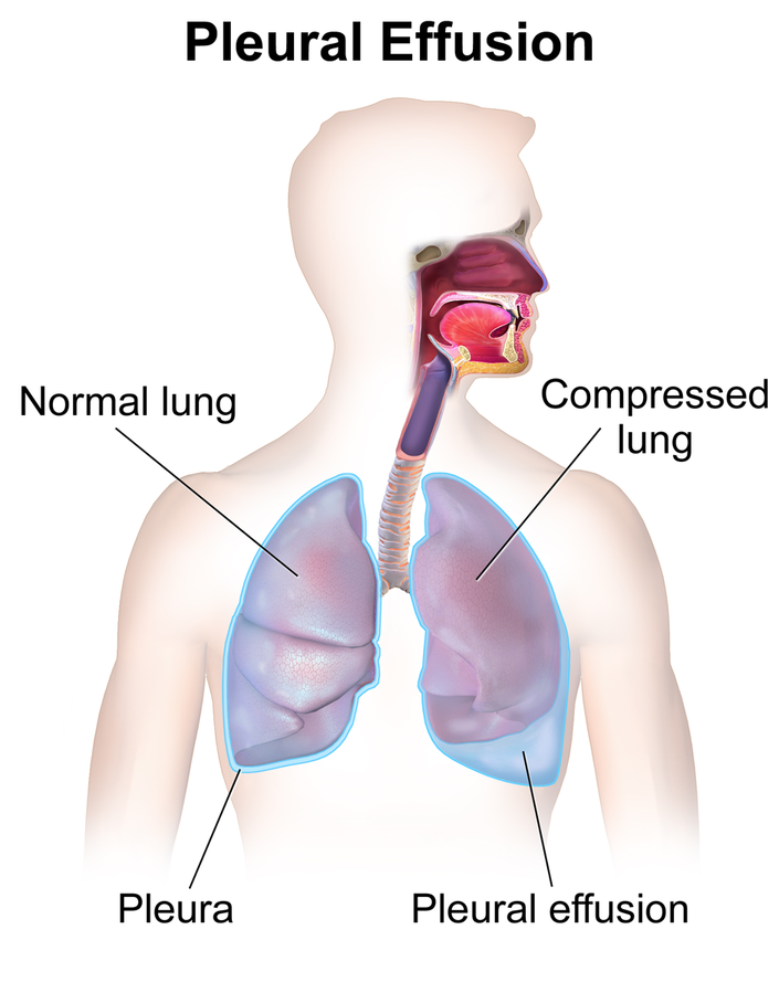 Illustration showing pleural effusion in a compressed lung