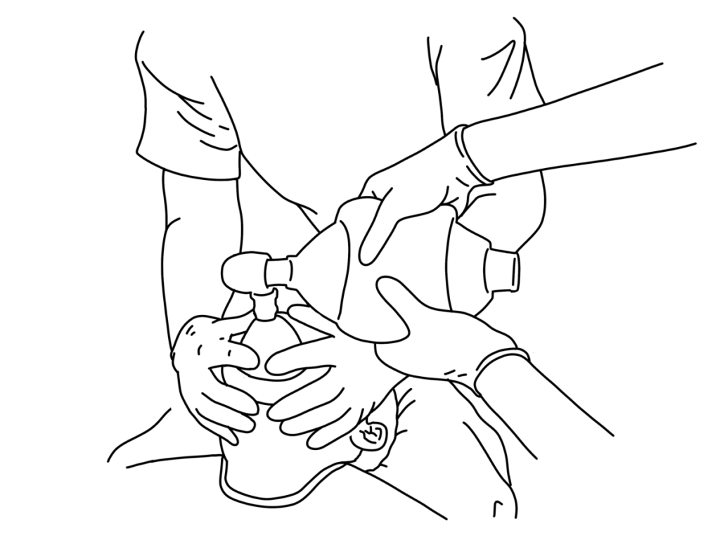 Illustration demonstrating the two person bag valve ventilation