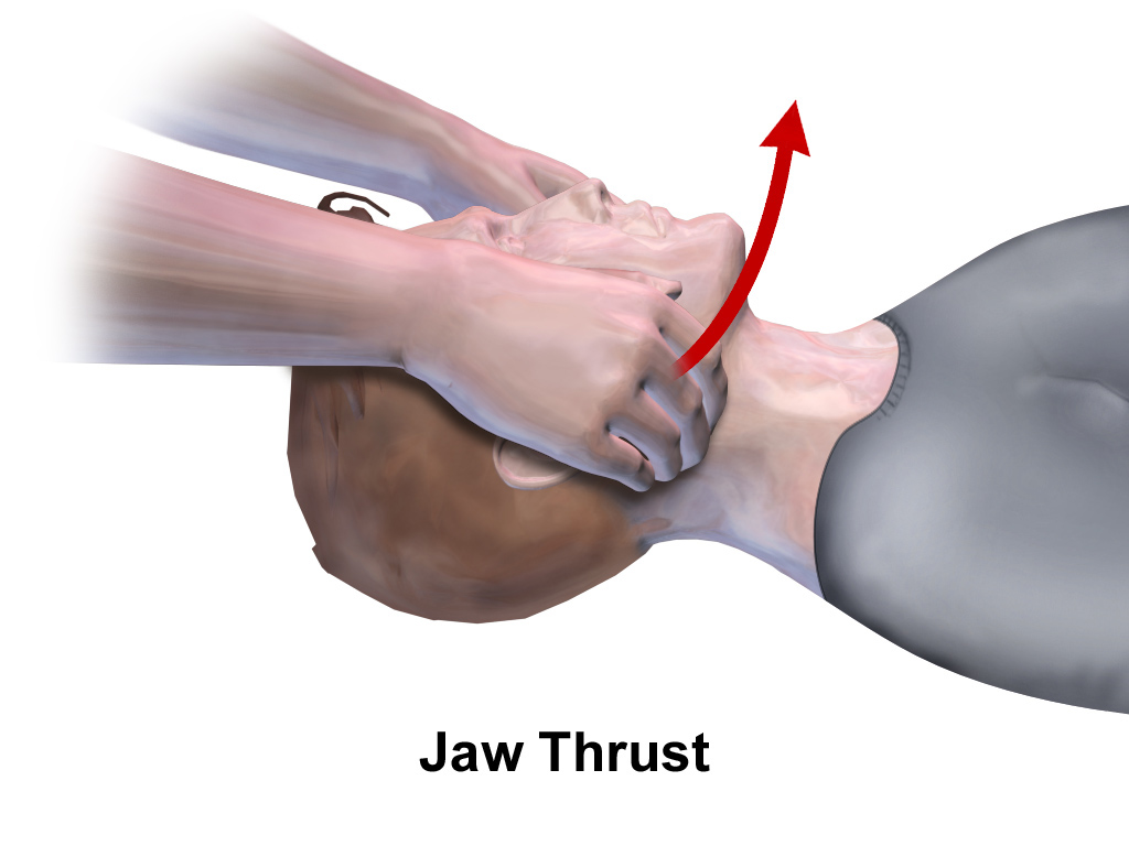 Illustration demonstrating direction to lift a patient's head in jaw thrust maneuver
