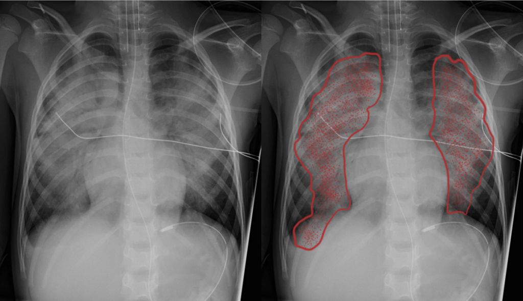 X ray showing a comparison of normal lungs with those affected by acute pulmonary edema
