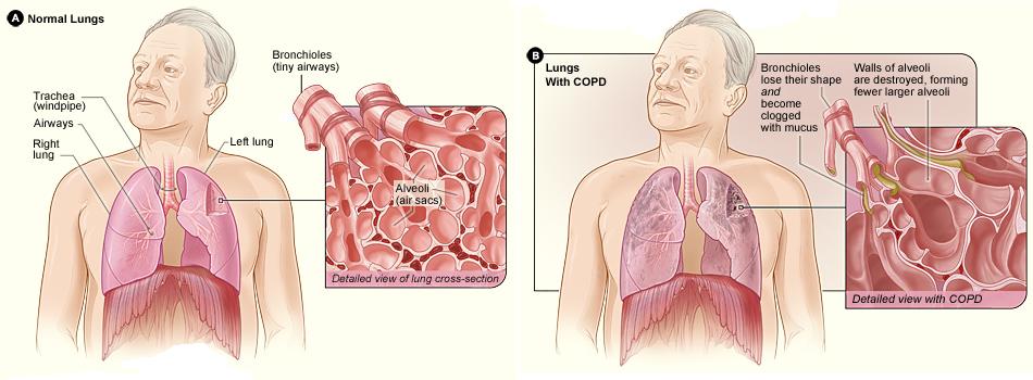 Illustration comparing appearance of normal lungs with those of a person with C O P D