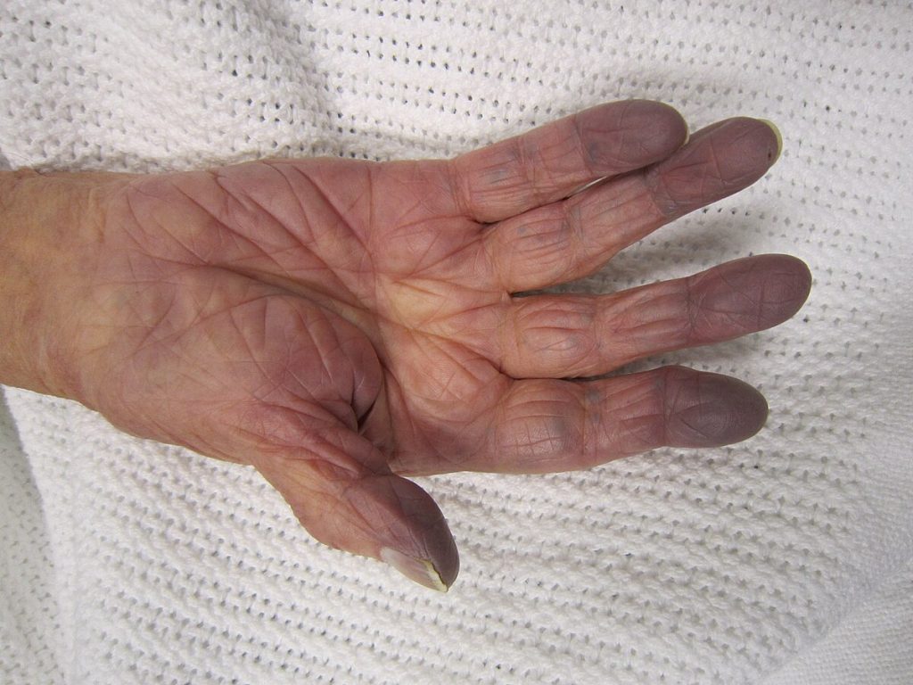 A hand exhibiting darkened fingertips, indicative of cyanosis