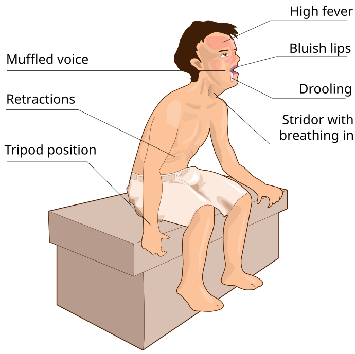 Illustration showing a simulated patient demonstrating symptoms of epiglottitis