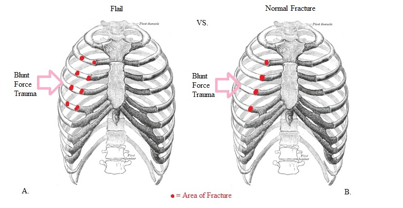 Illustration comparing a flail chest fracture to a normal chest fracture