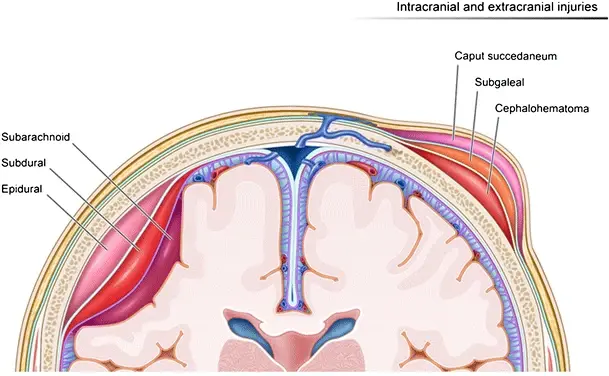 Illustration showing hemorrhages by location within different layers of the meninges and scalp