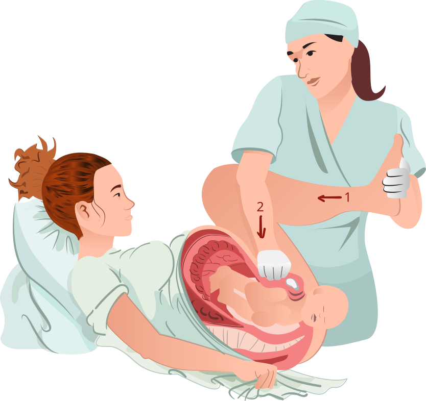 Illustration demonstrating McRobert's maneuver for delivering a baby with a stuck shoulder