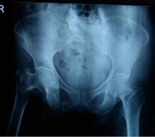 X ray showing fracture on neck of femur of right hip