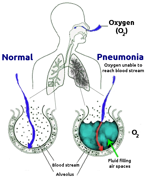 Illustration comparing normal alveolus with those affected by pneumonia