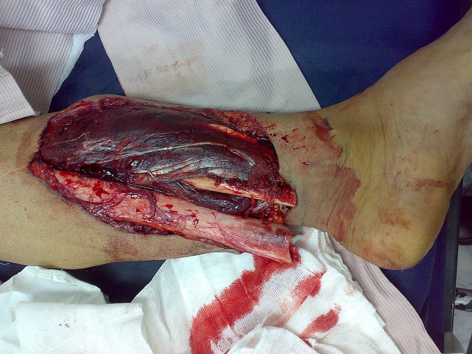 Open fracture on the lower leg with significant bleeding and bone sticking out