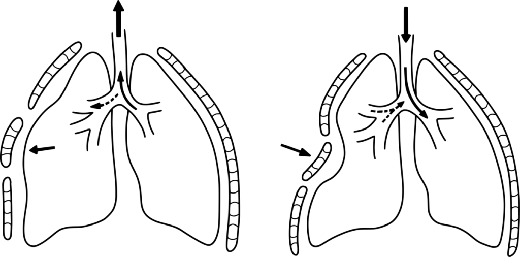 Illustration showing process of paradoxical breathing caused by an unstable chest wall