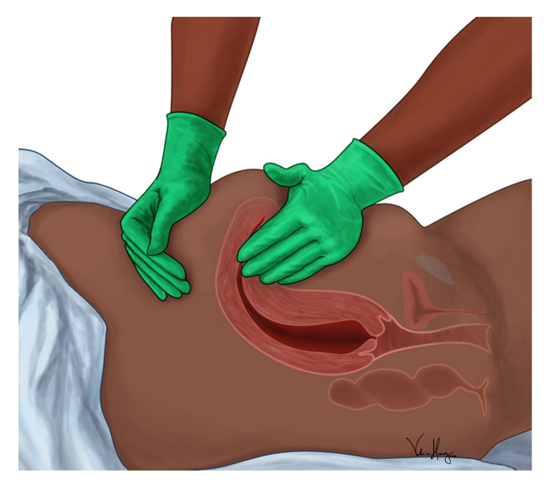 “Side_View_of_Postpartum_Uterine_Massage_with_Internal_Anatomy” by Valerie Henry is licensed under CC BY-SA 4.0 Illustration showing a provider performing a fundal massage