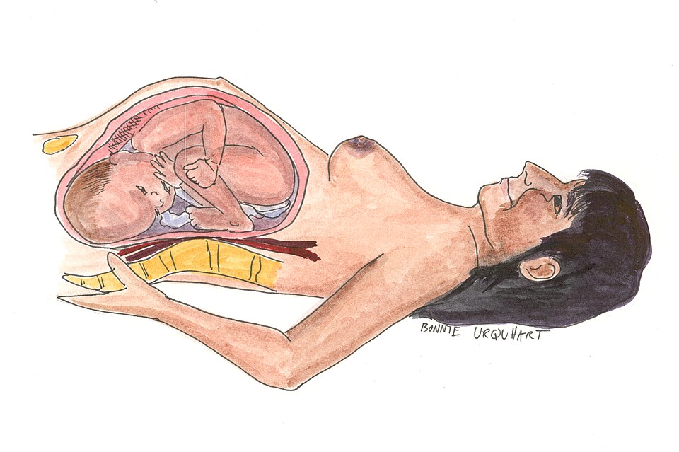 Illustration showing the internal mechanics that cause Supine_hypotensive_syndrome