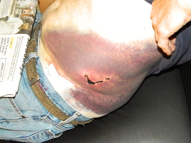Substantial bruising along a patient's right side and abdomen from an injury