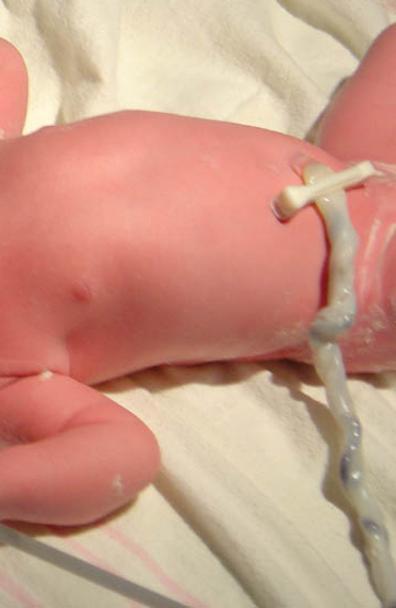 Umbilical cord with umbilical clamp