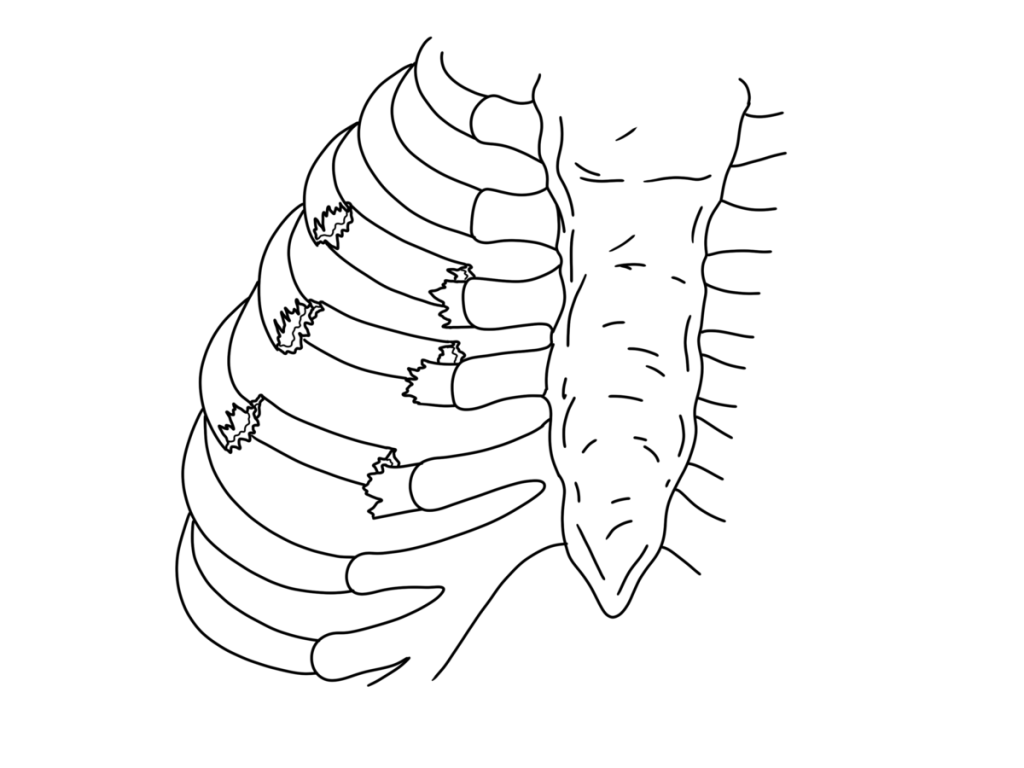 Illustration showing an unstable chest wall, caused by rib fractures