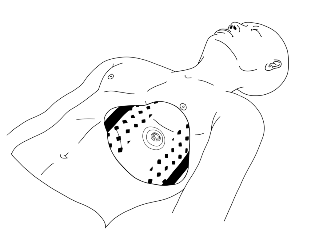 Illustration showing a vented chest seal