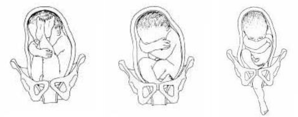 Illustration showing three breech fetal positions